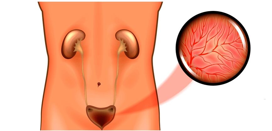Zystitis bei Symptomen und Behandlung von Männern